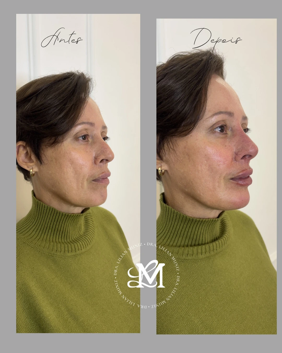 Comparação de resultado de harmonização facial, registro 2 fornecido pela Dra. Lilian