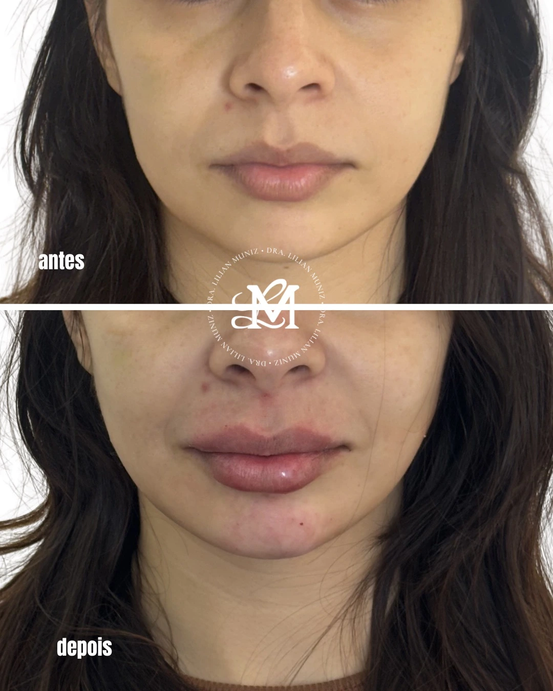 Comparação de antes e depois de preenchimento labial, caso 2 fornecido pela Dra. Lilian