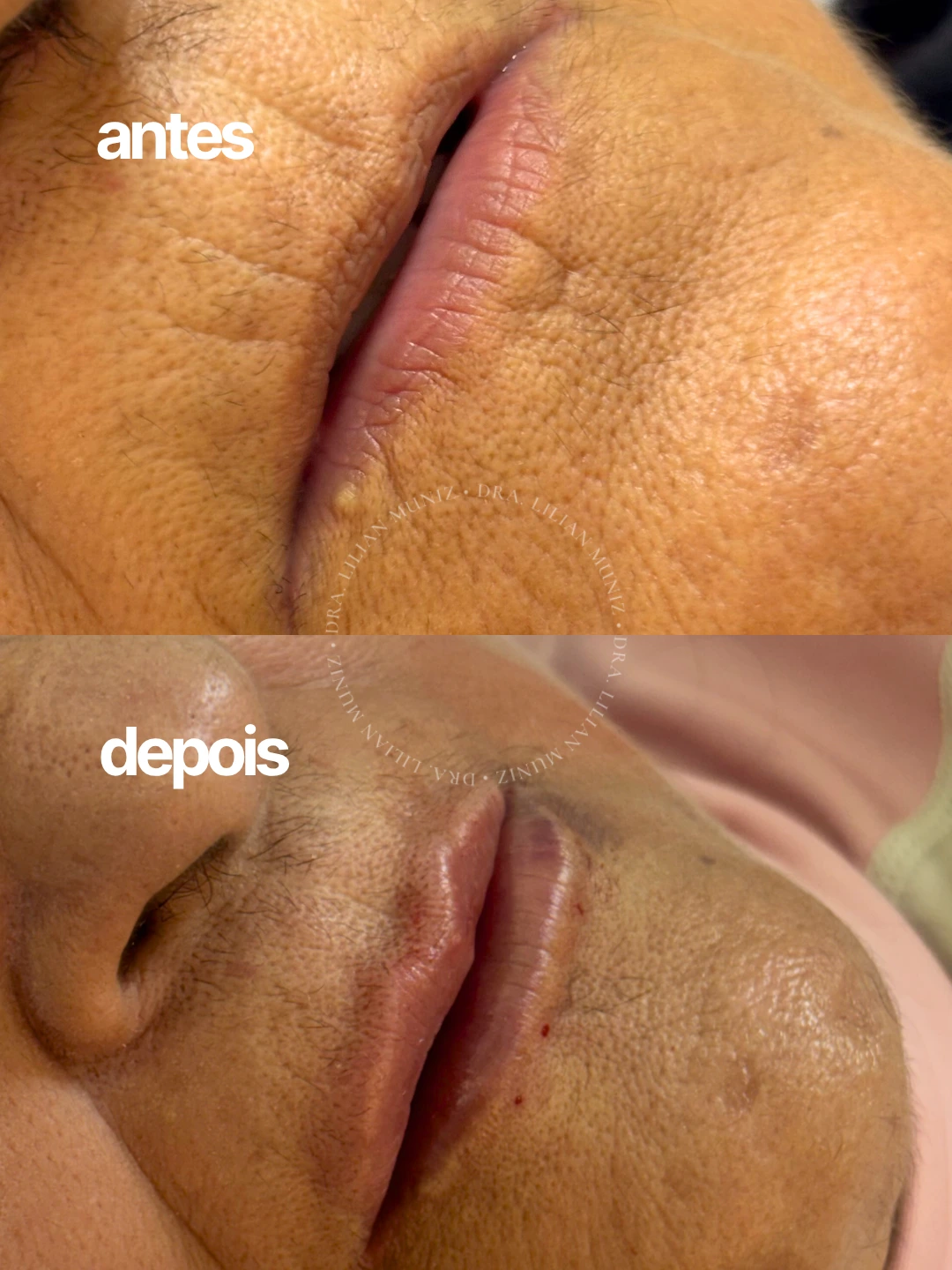 Comparação de antes e depois de preenchimento labial, caso 4 fornecido pela Dra. Lilian