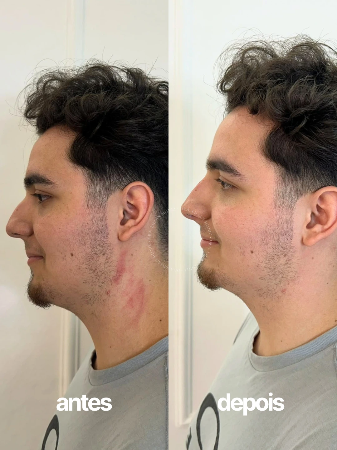 Registro comparativo de antes e depois de rinomodelação, caso 1, fornecido pela Dra. Lilian Muniz